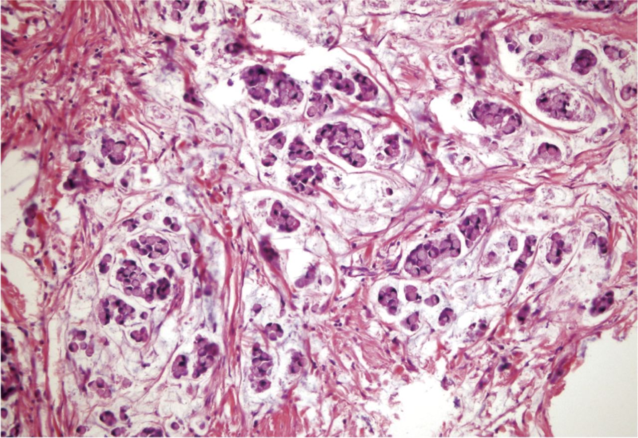 Gastric adenocarcinoma of fundic gland type with signet-ring cell carcinoma  component: A case report and review of the literature